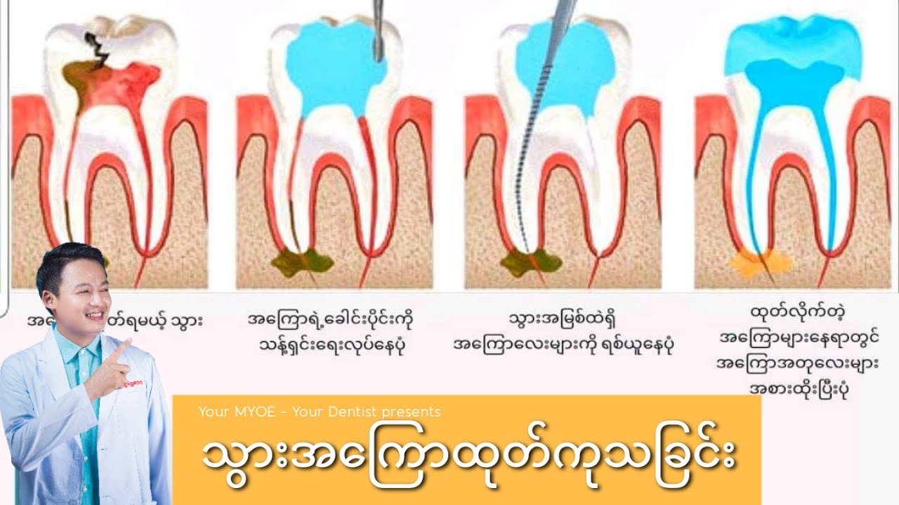 သွားအကြောထုတ်တယ်ဆိုတာ ဘာလဲ? #YourMYOE #YourDentist