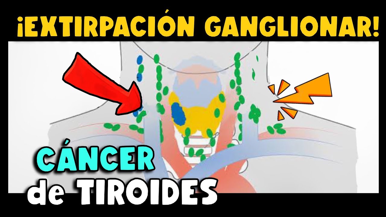 ¡IMPORTANTE! DISECCIÓN GANGLIONAR EN CÁNCER DE TIROIDES ¿CUÁNDO EXTIRPAR LOS GANGLIOS DEL CUELLO?