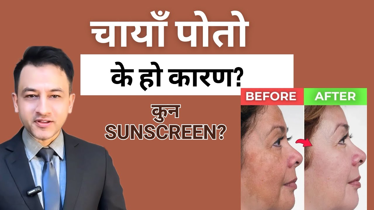 10 frequently asked questions in Melasma