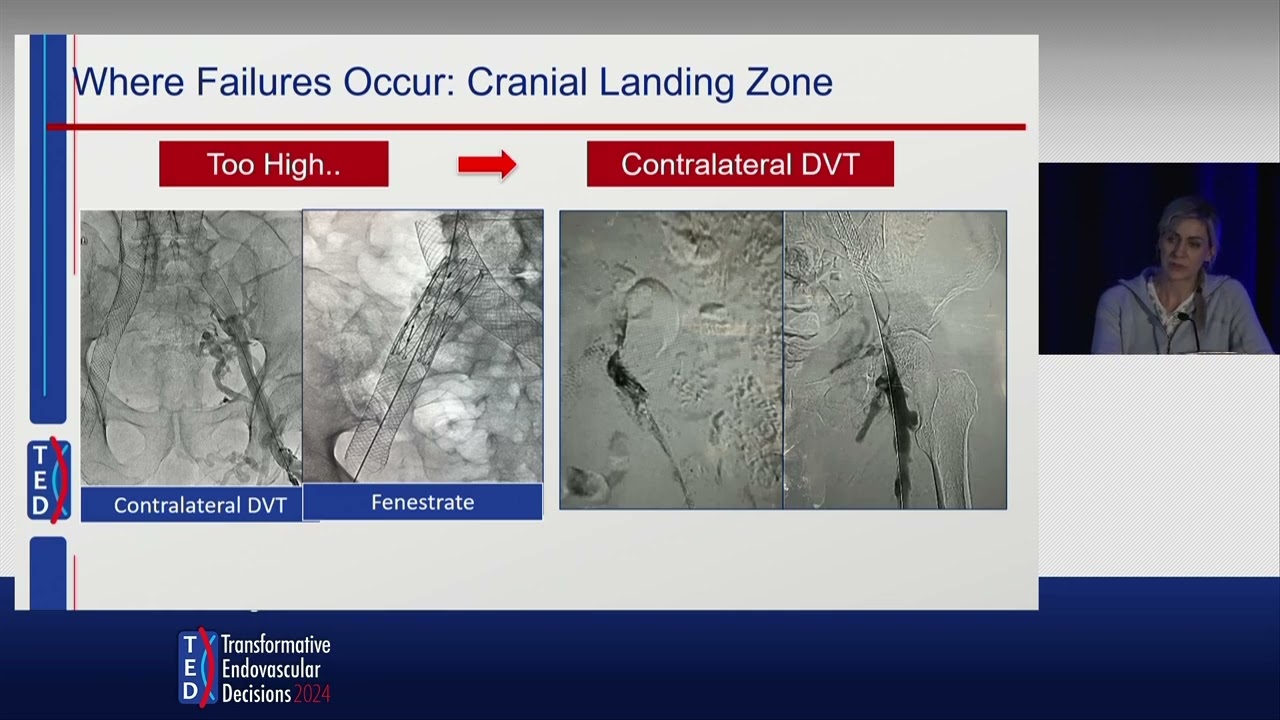 Chronic DVT and Venous Stent Failures: My Best Advice | Dr. Erin Murphy at TED 2024