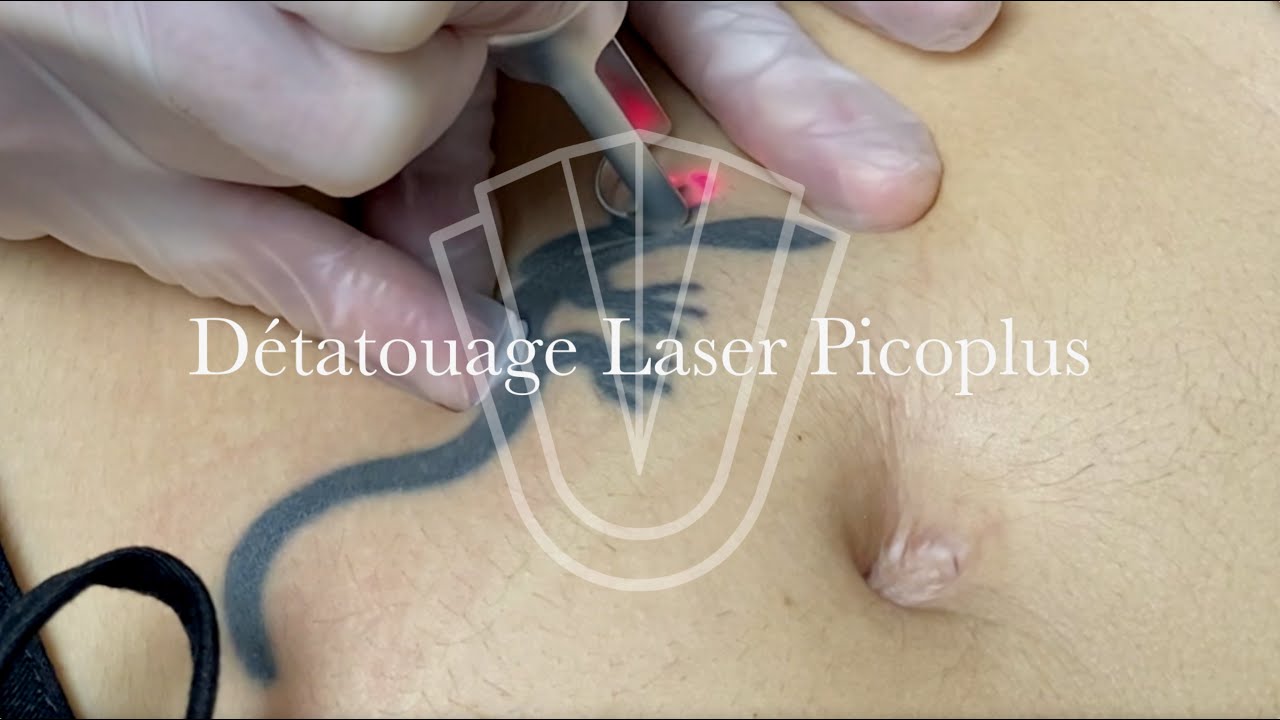 Détatouage Laser Picoplus - Clinique Bellefontaine Lausanne