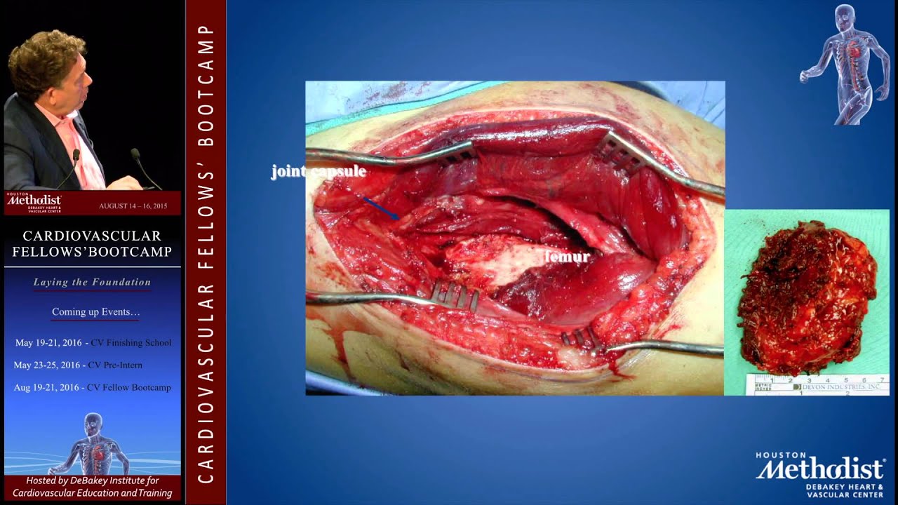 Diagnosis and Management of AVM's (Alan B. Lumsden, M.D.)