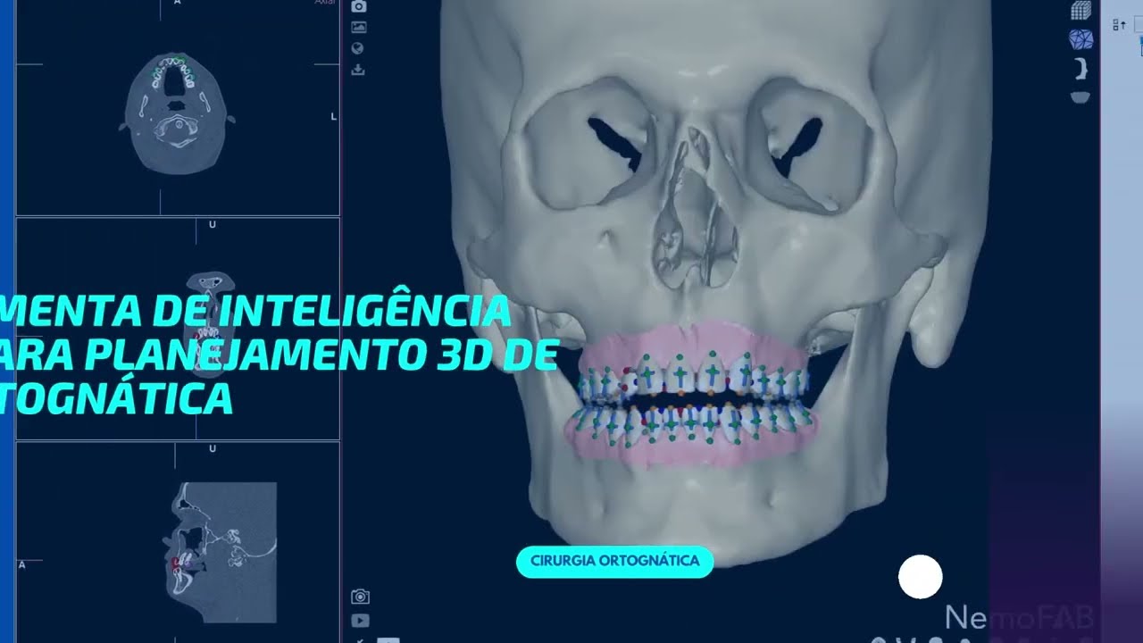 Nova ferramenta de IA no Software da Nemofab - Planejamento 3D da Cirurgia Ortognática