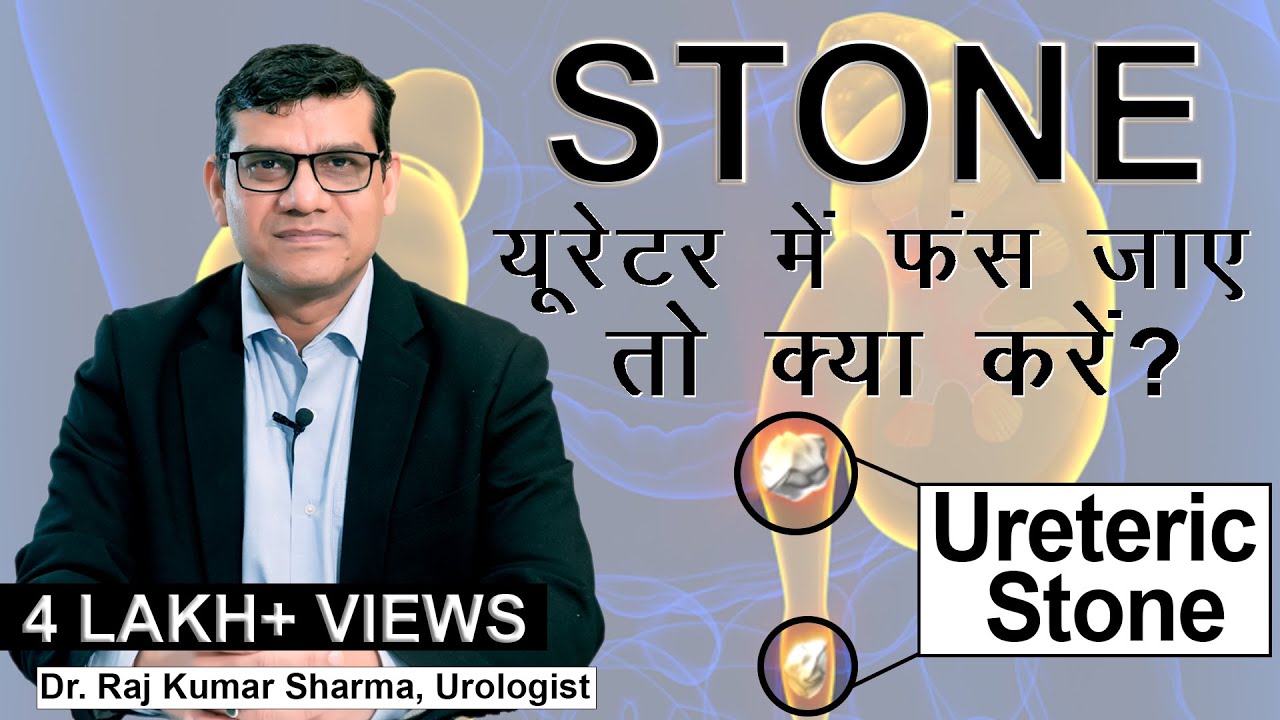 Ureter मैं फंसी  हुई पथरी/ Kidney Stone  in Ureter - Symptoms and Treatment || Dr. Raj Kumar Sharma
