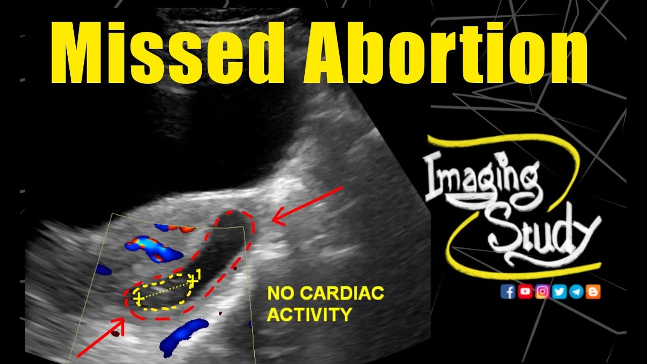 Missed Abortion | 9-10 Weeks || Ultrasound || Case 331