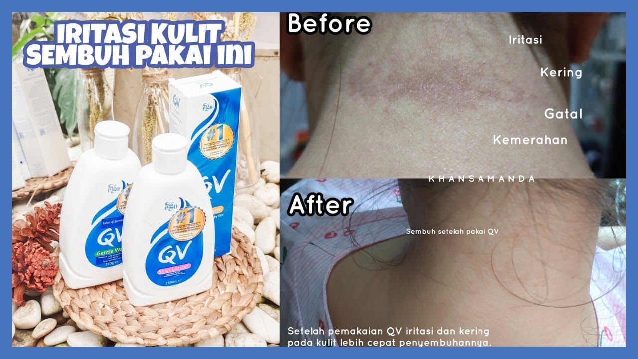 [Review] Iritasi Cepat Hilang Pakai QV Skincare | Khansamanda