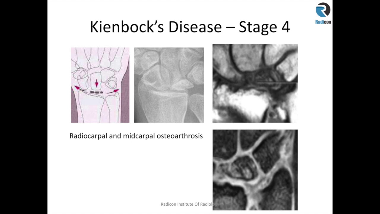 Wrist MRI Part 1: Carpal Bones