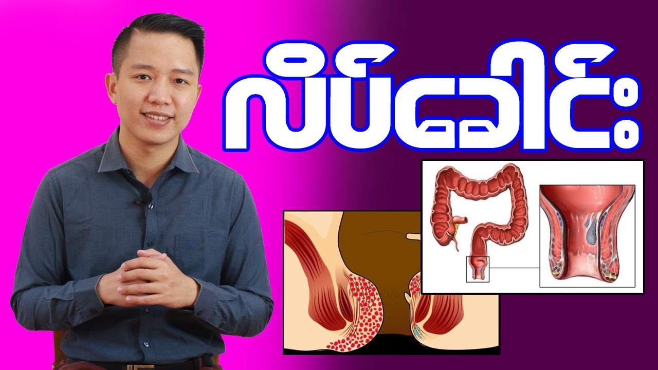 လိပ်ခေါင်းဘာကြောင့်ဖြစ်ရတာလဲ ဆိုတာ သိပြီးပြီလား?