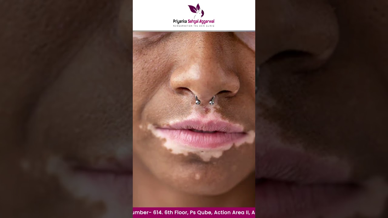 Expert Vitiligo Treatment at Reincarnation Skin Clinic!