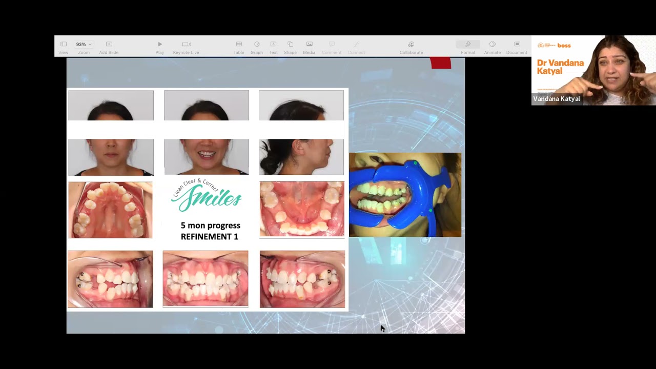 Invisalign Transformation! Open Bite and premolar extractions (With Virtual Dental Monitoring)
