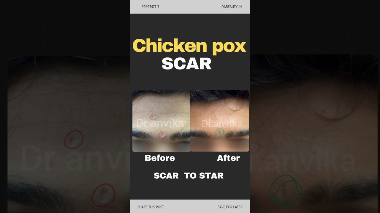 Chicken pox scars || How to Remove Chicken Pox Scars || Effective Scar Treatment || bye Dr Anvika