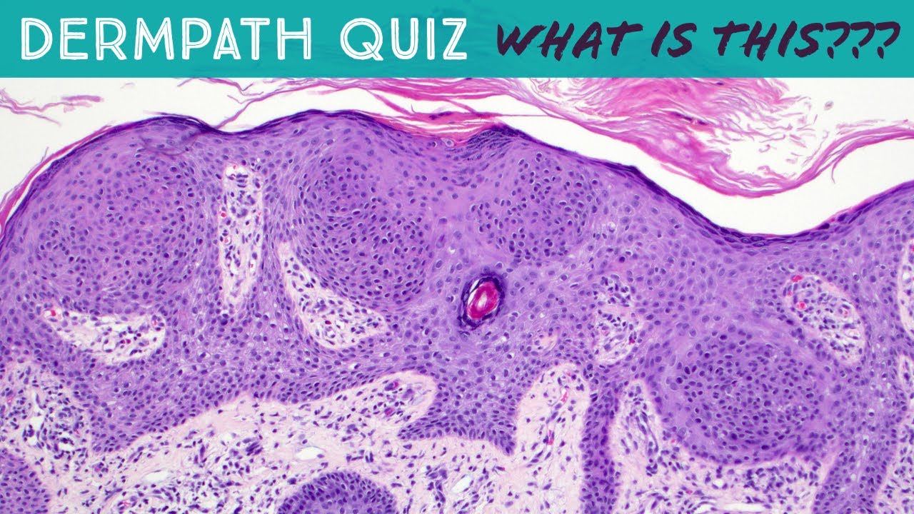 Dermpath Quiz Case - What is the diagnosis? (answer link in video description) pathology dermatology