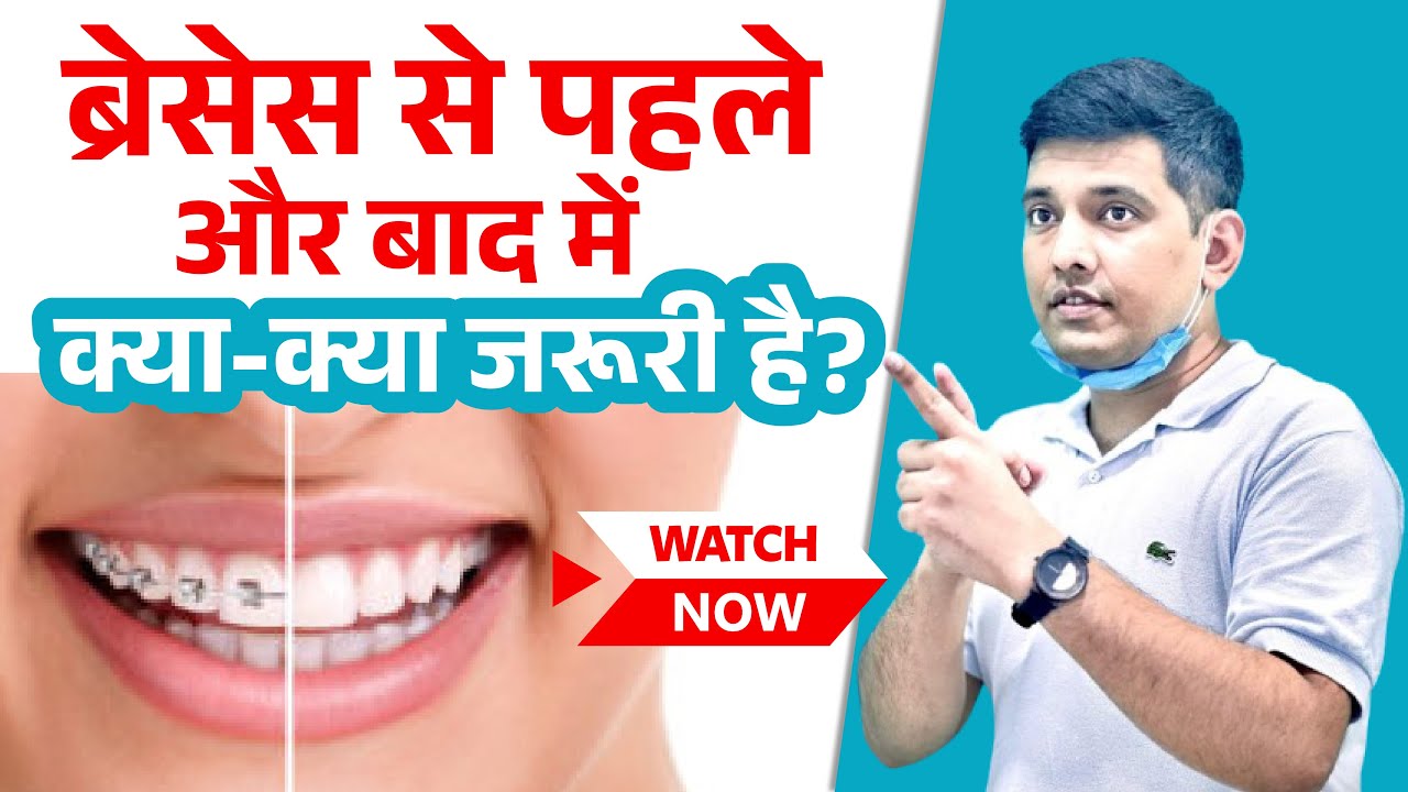 Watch this before getting Braces | Complete Braces care