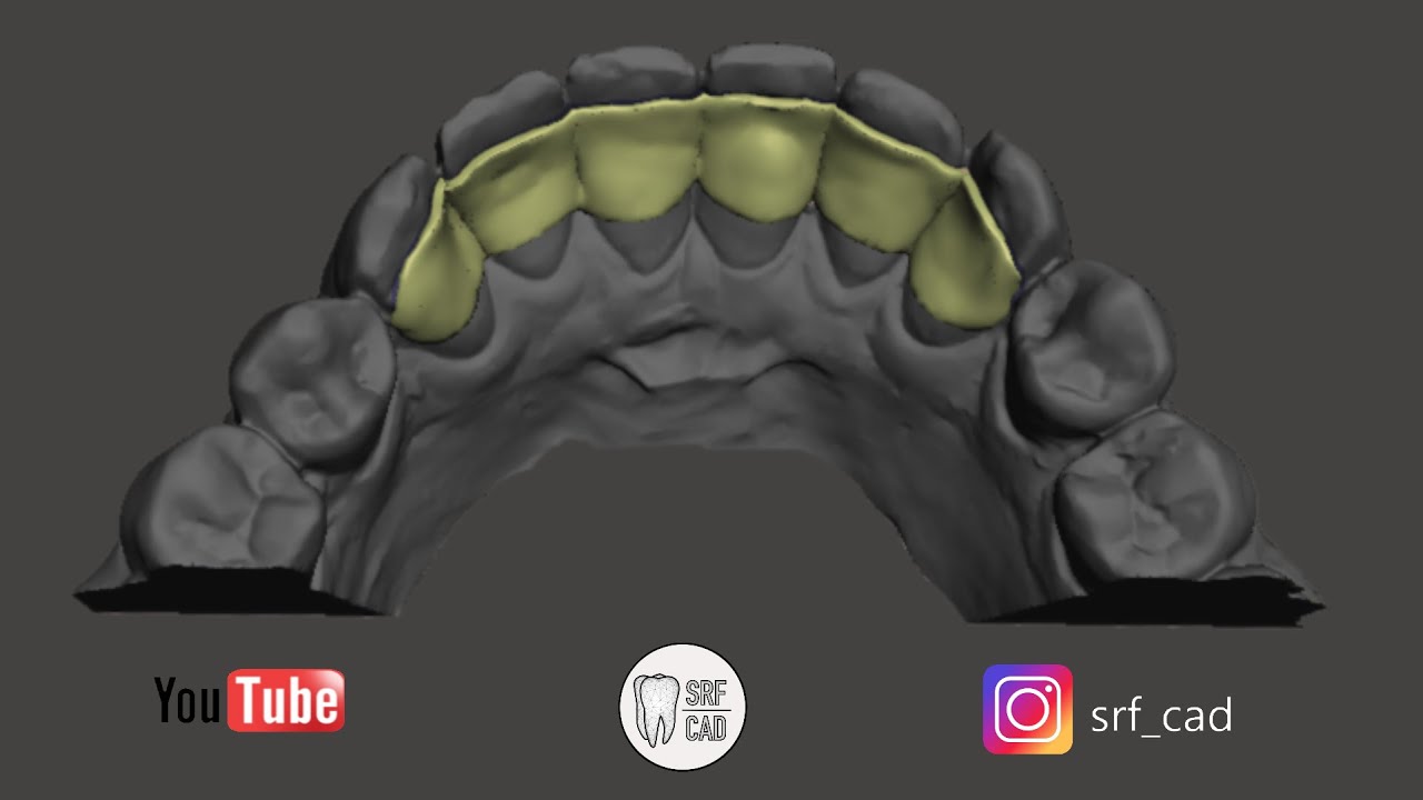 MESHMIXER DENTAL:Tutorial come eseguire uno splintaggio da impronta intraorale Ortho splint retainer