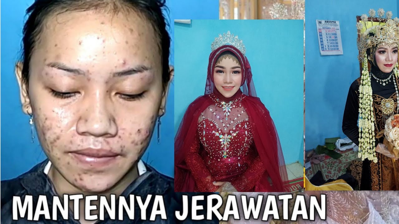 Aslinya jerawatan Parah.. Hasilnya Bikin Pangkling