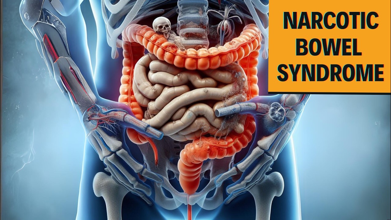 Narcotic Bowel Syndrome : douleur rare mais intense