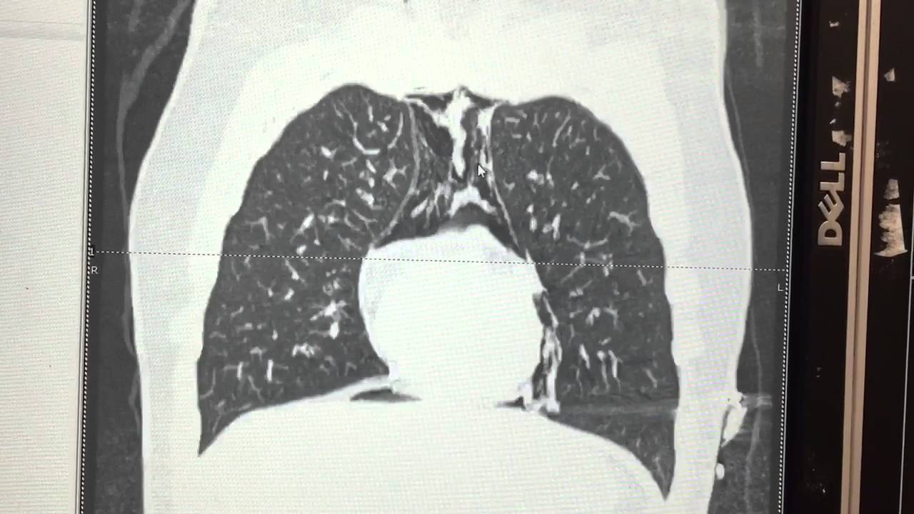 CT scan of chest - pneumopericardium