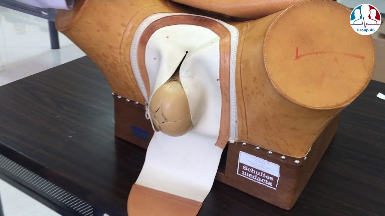 Occipito-posterior presentation