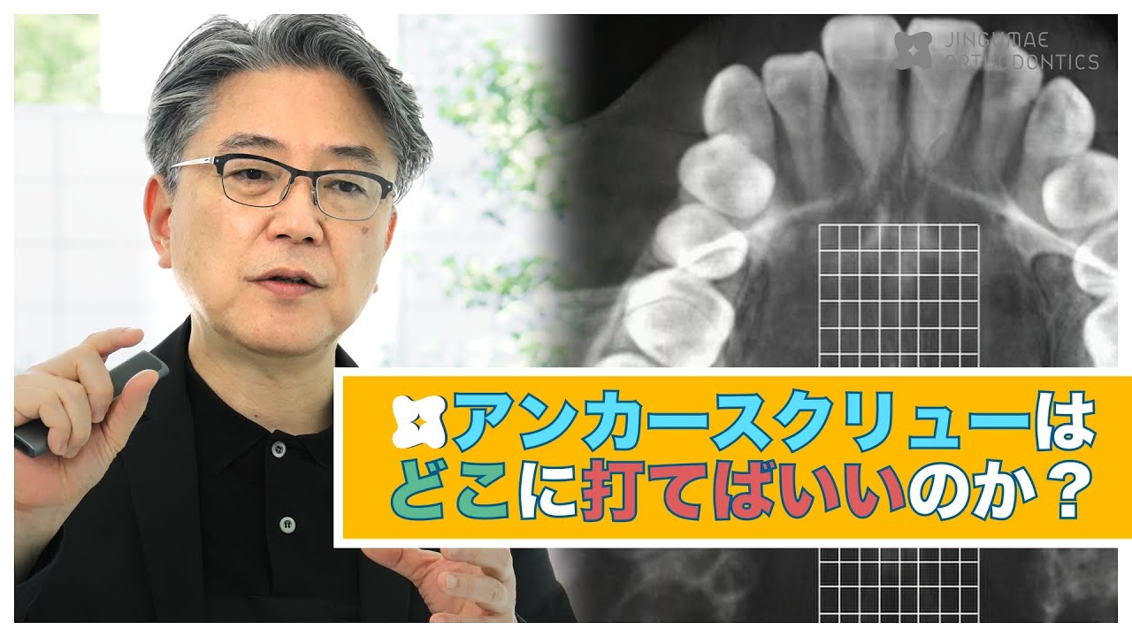 矯正治療でアンカースクリューはどこに打てばいいのか？