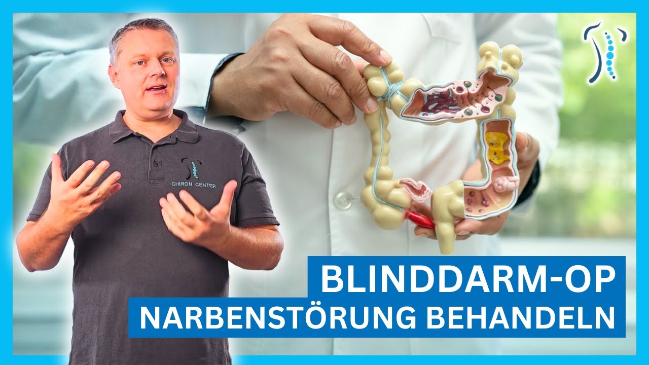 Bauchschmerzen nach Blinddarm-OP? Ursache könnten Faszien sein!