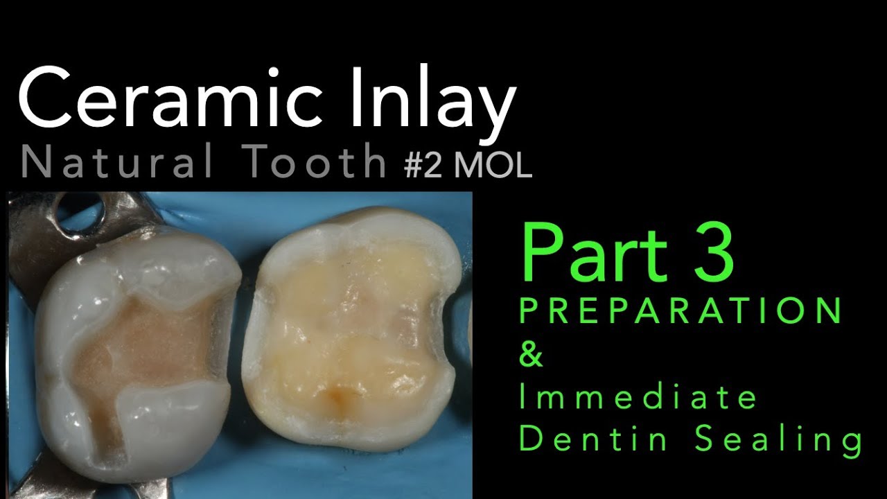 Lithium Disilicate Ceramics, Part  3: Preparation and Immediate Dentin Sealing (IDS)