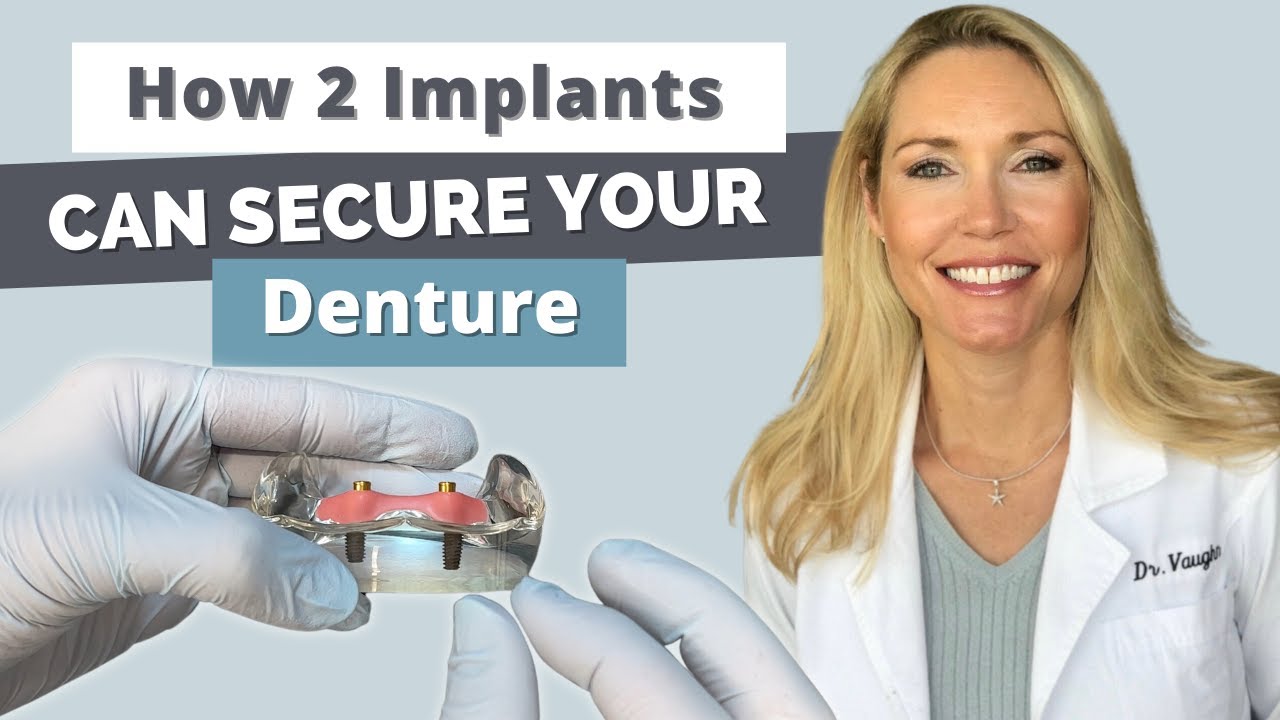 Snap In Dentures: How 2 Implants Can SECURE Your Conventional Denture