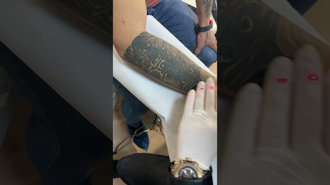 Dövme Silme İşlemi