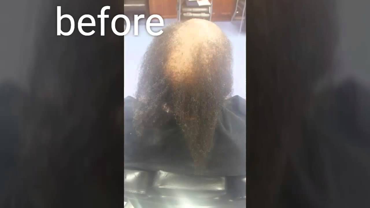 Lace frontal installment with hair loss