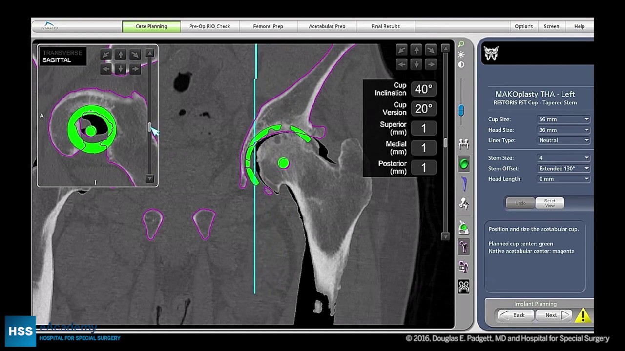 Total Hip Arthroplasty Posterior Approach with Robotic Assistance: Part 1