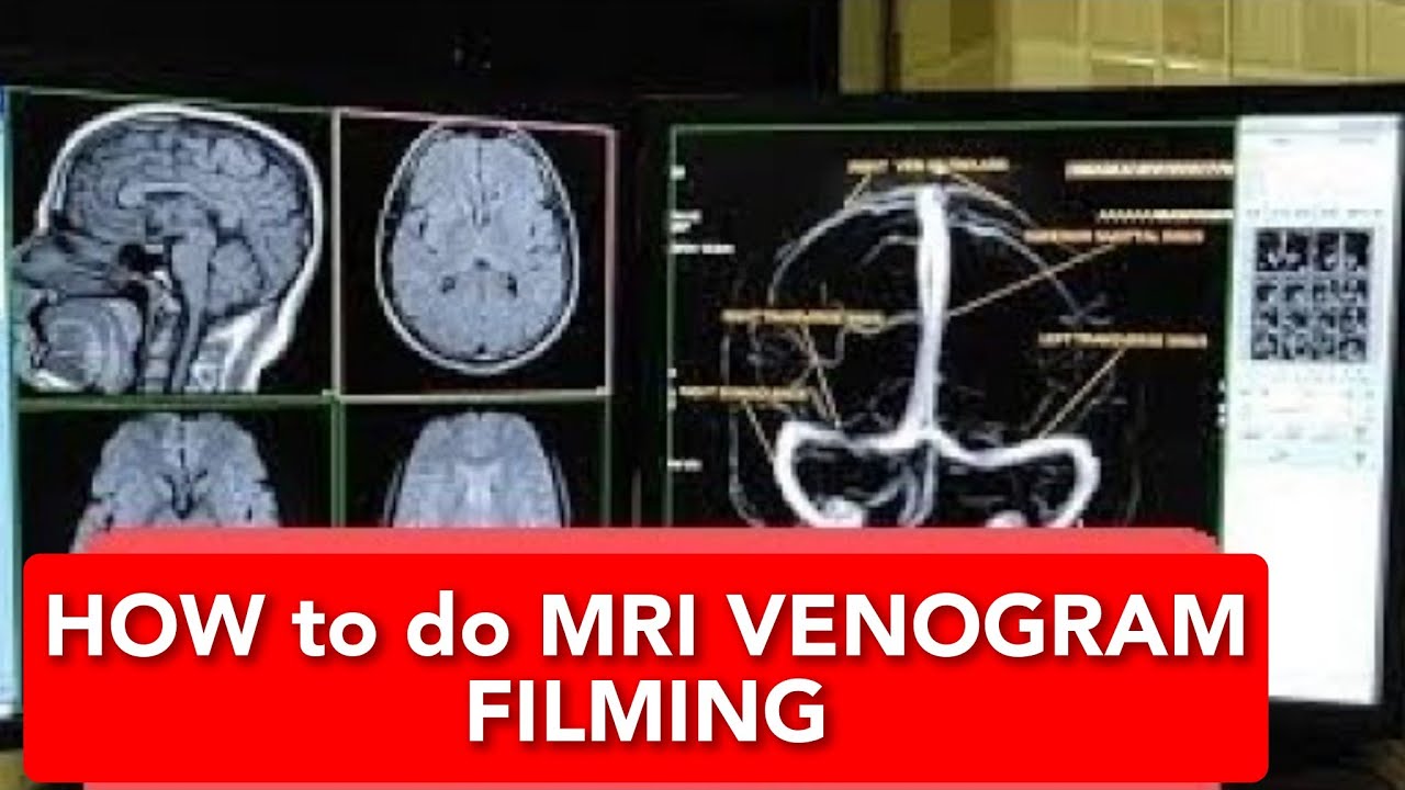 Venography MRI scan Filming Protocol.