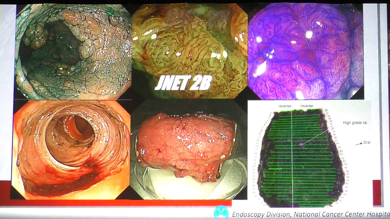 06 Yutaka Saito Диагноз по JNET и лечение колоректального рака Новый взгляд на зубчатую аденому