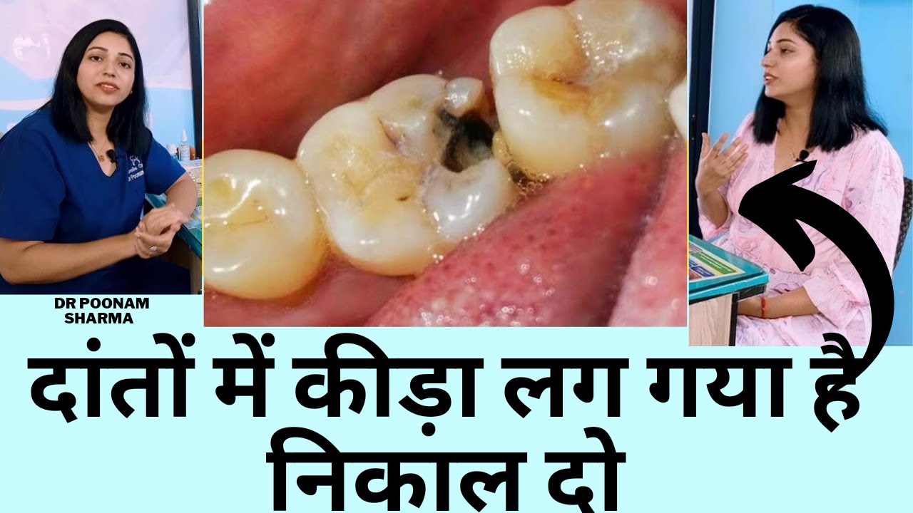 दांतो के कीड़े कैसे निकाले ?| Dental Cavity Treatment | Dant ke  Kide Ka Ilaj In Hindi