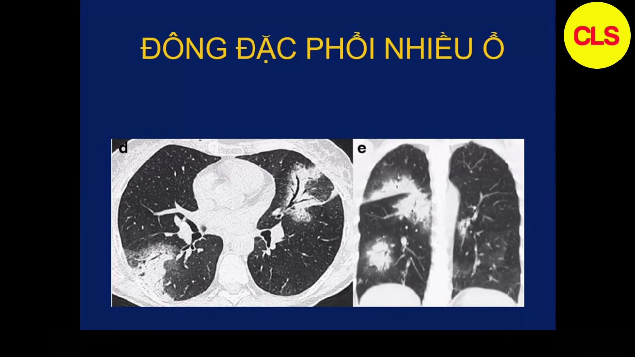 Tổn thương cơ bản trên CLVT phổi  | TS. BS. Đoàn Tiến Lưu