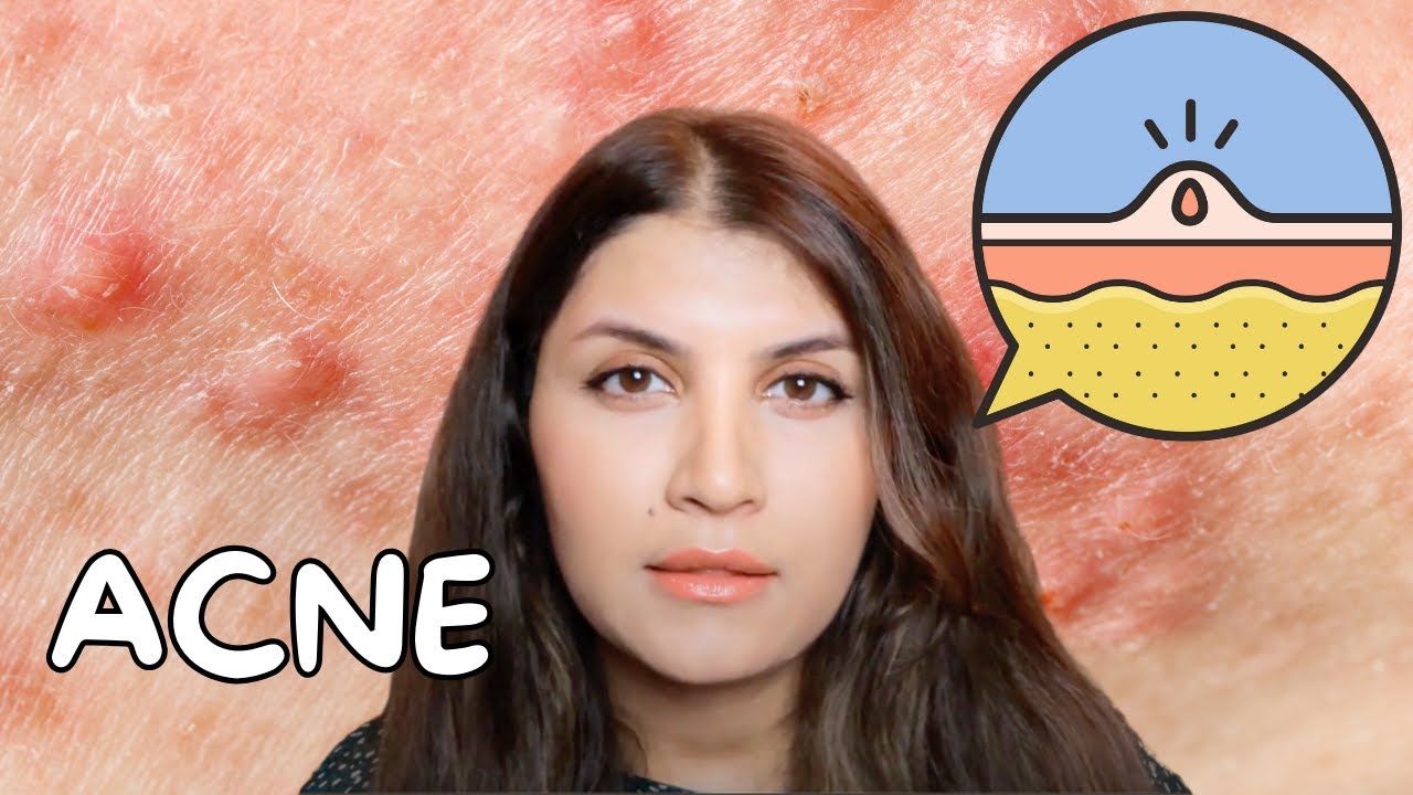 How to treat Acne - Dermatologist Guide!