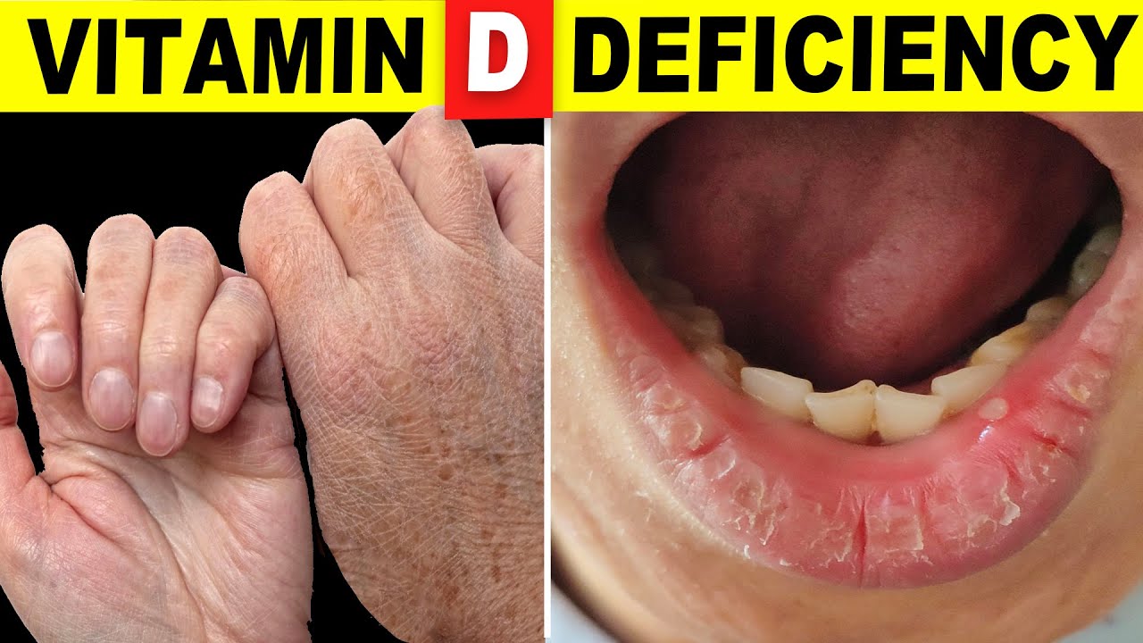 10 Signs Your Body Is Begging for Vitamin D