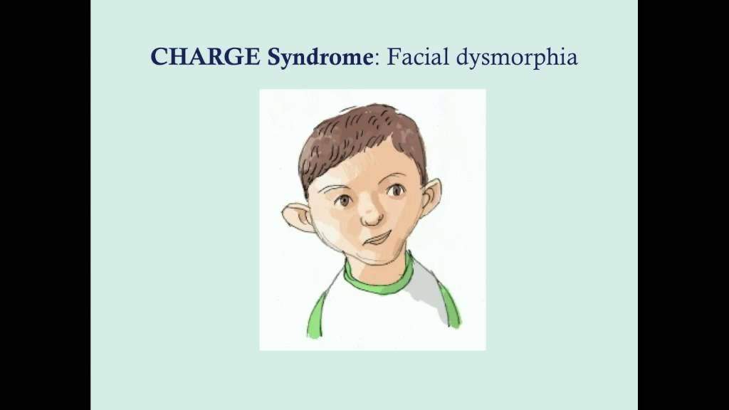 CHARGE Syndrome - CRASH! Medical Review Series