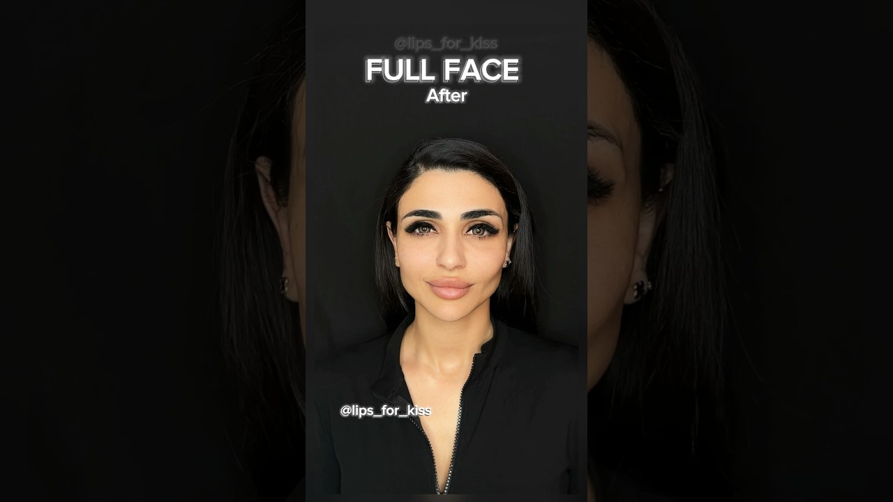 Full face correction #recommended #рек #filler #jawline #beauty #fullface #lipfiller #botox