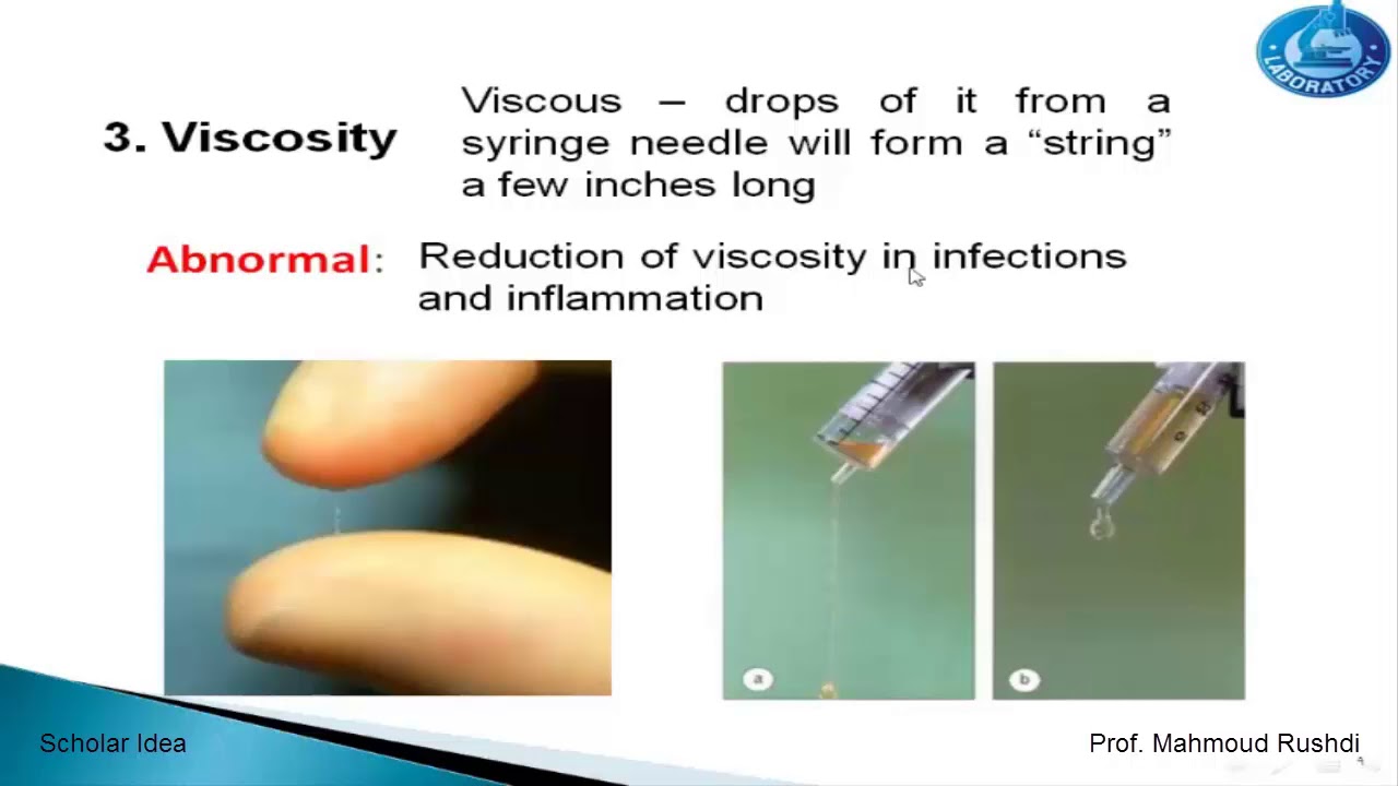 Analysis of the synovial fluid (Joint Fluid)