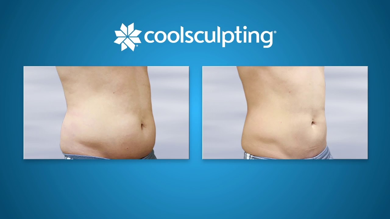 Resultados WOW en abdomen con Coolscultpting en @Clinica LEMEL