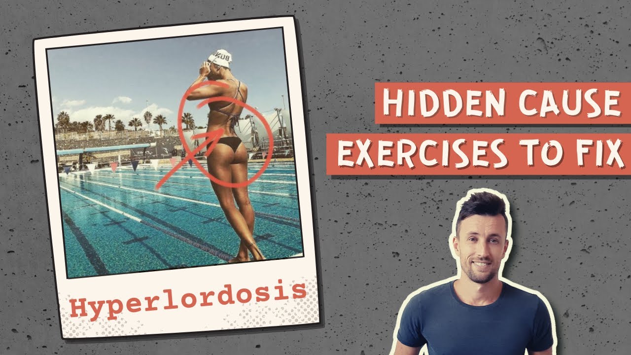 How to Fix a HYPERLORDOSIS (Sway Back) | Hidden Cause Explained!