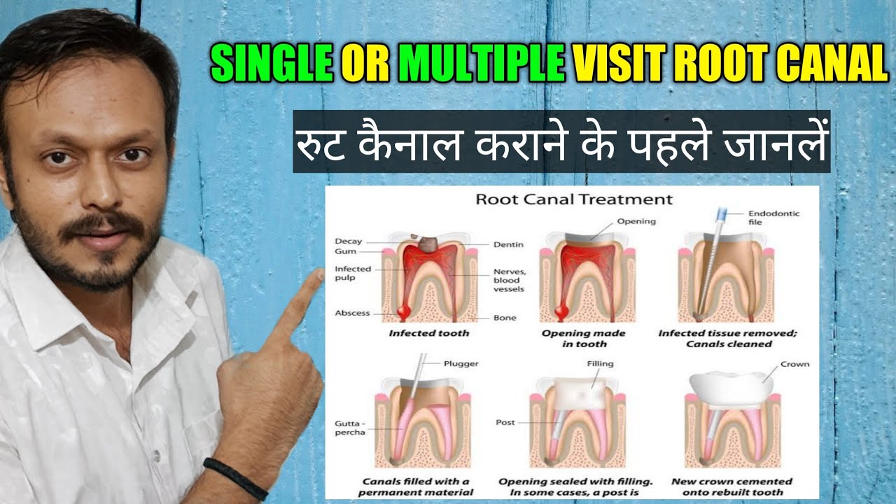 Single or Multiple visit Root Canals Treatments in Hindi |रुट कैनाल ट्रीटमेंट |