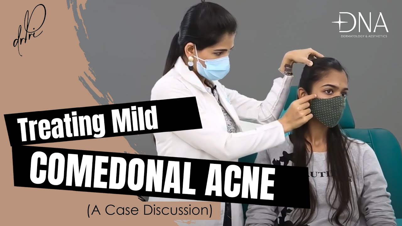 How to treat mild comedonal acne: tips from a dermatologist | Dr. Priyanka reddy