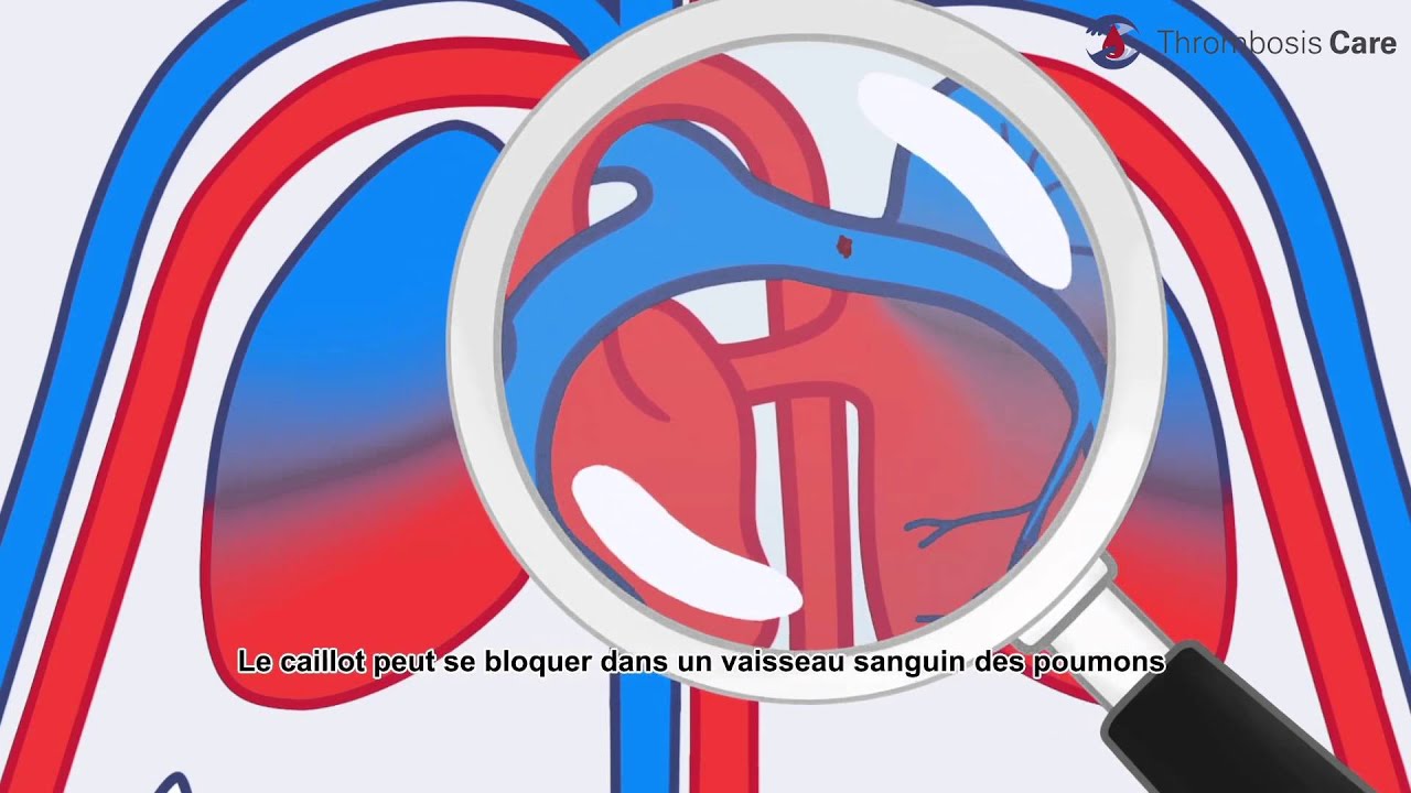 embolie pulmonaire