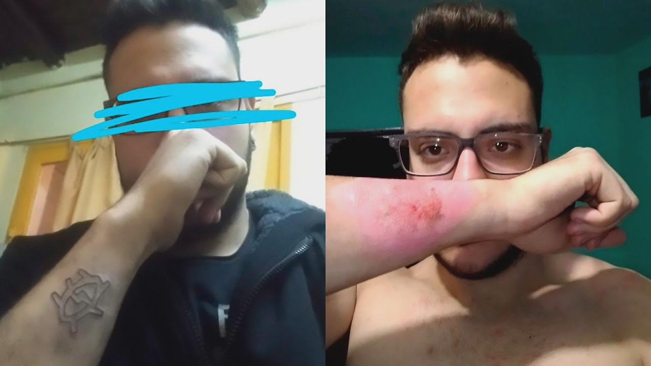 Man Uses Cheese Grater to Remove Tattoo?