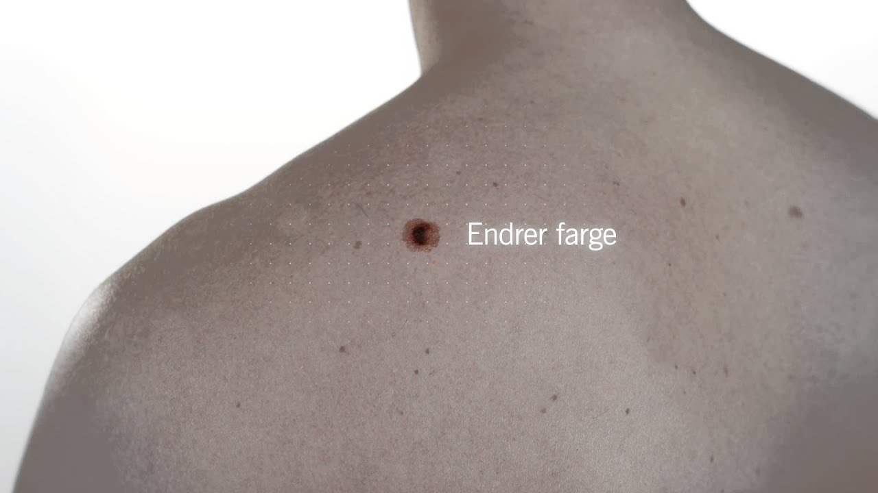 Hold øye med føflekkene dine | Kreftforeningen