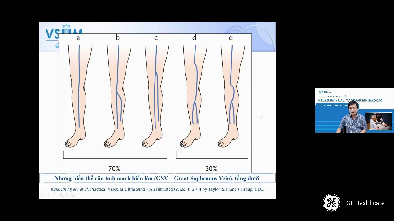 [CME SAMM] 6.1 Siêu âm chẩn đoán huyết khối tĩnh mạch ngoại vi - BS Nguyễn Quang Trọng
