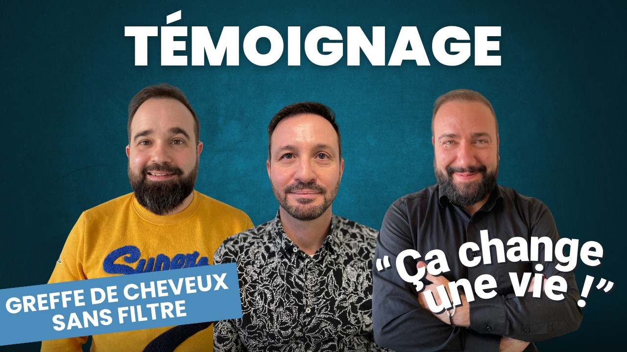 Avant-Après Greffe de Cheveux : Évolution sur 12 Mois (Témoignage)