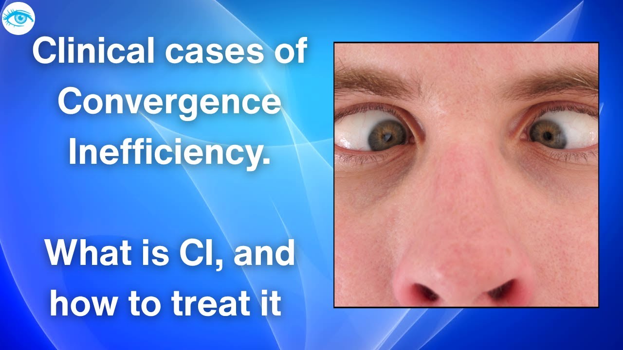@eyeoptometrist  Clinical cases of Convergence Inefficiency.What is CI and how to treat it 