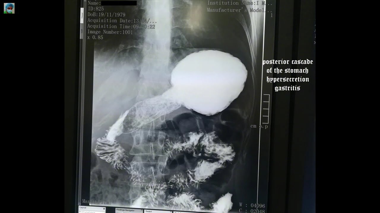 Radiology x ray cases online Library part 87 Esophagography Gastrography Irrigography Barium studies