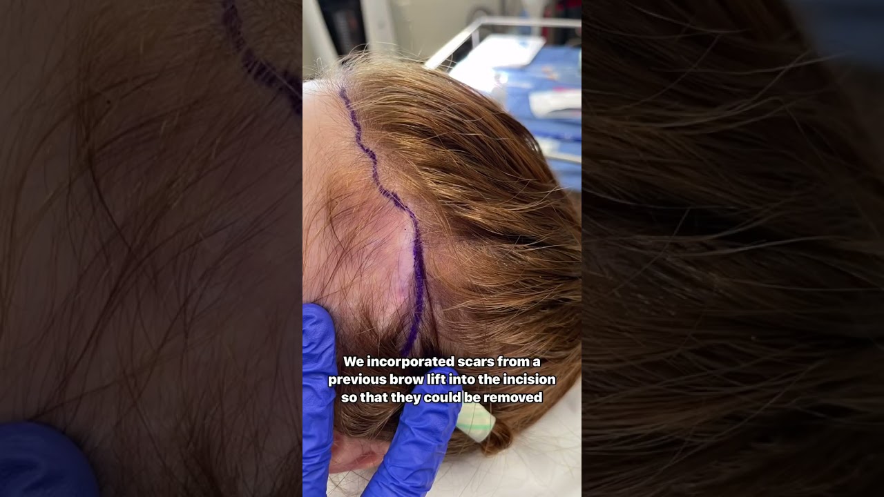 Brow Bone Reduction for Women | Dr. Sarah Saxon